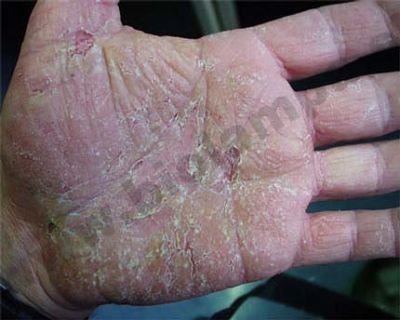 Psoriasis - Psoriasis 