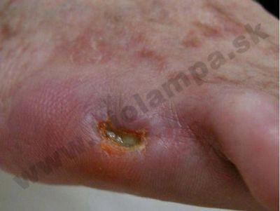 Cicatrice d'amputation chez un patient diabétique 