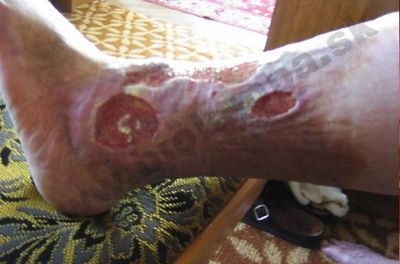 Ulcères de Bercus (ulcères du tibia) 